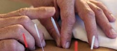 acupuntura-pinhais-1379377039